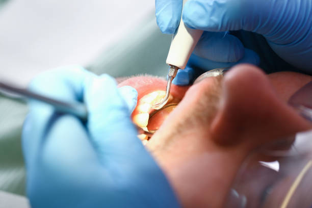 Best Knocked-Out Tooth (Avulsed Tooth) Treatment in West Pensacola, FL